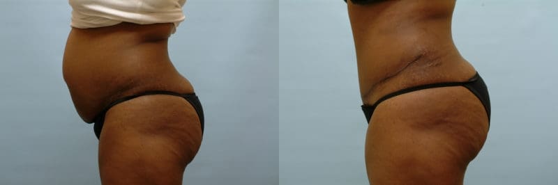 Tummy tuck before and after result, case 12