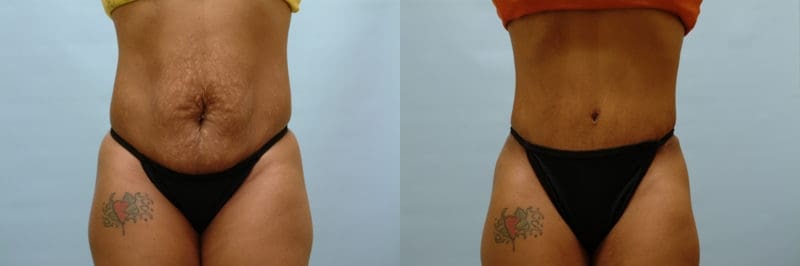 Tummy tuck before and after result, case 13