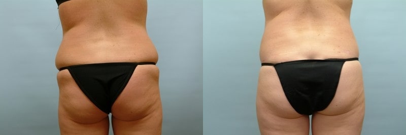 Waist tuck before and after result, case 04